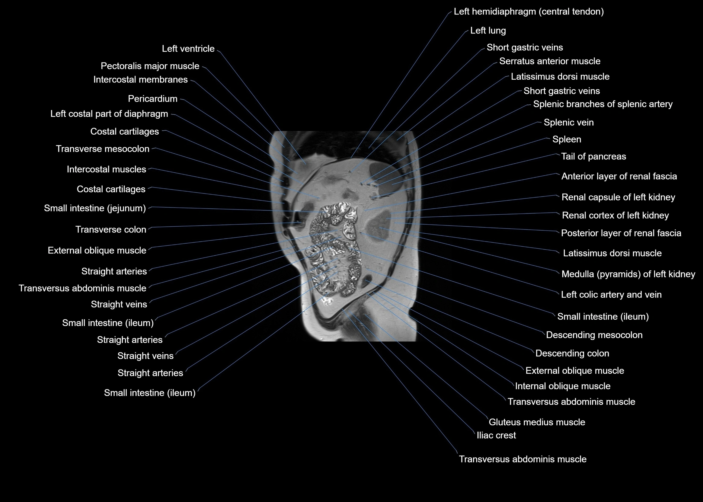 MRI abdomen sagittal cross sectional anatomy  radiology  image-img-00001-00056.webp